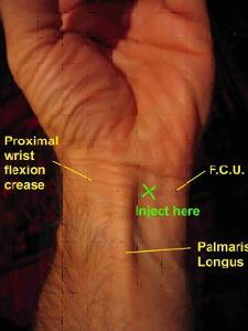 proximal wrist crease.