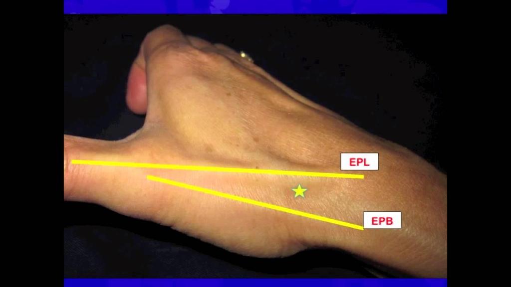 snuffbox EPL / APL/EPB tendons. Palpate the 1 st CMCJ here.
