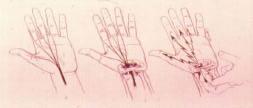 Phalen s Test Tinel s Sign Often, the symptoms can be duplicated or worsened by bending the wrist firmly palmward for 60 seconds
