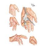 Dupuytren s Disease Contracture Commonly found in northern European countries and