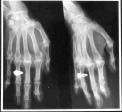Osteoarthritis of the Fingers Degenerative Arthritis Osteoarthritis of the Fingers Degenerative Arthritis Chronic and progressive articular pathology Characterized by deterioration of cartilage along