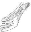 The swollen tendons and their coverings cause friction within the narrow tunnel or sheath