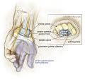 Median Nerve Most likely the disorder is due to a congenital predisposition - the carpal tunnel is simply smaller in some