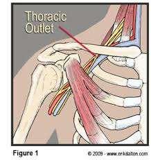 Thoracic outlet Pronator
