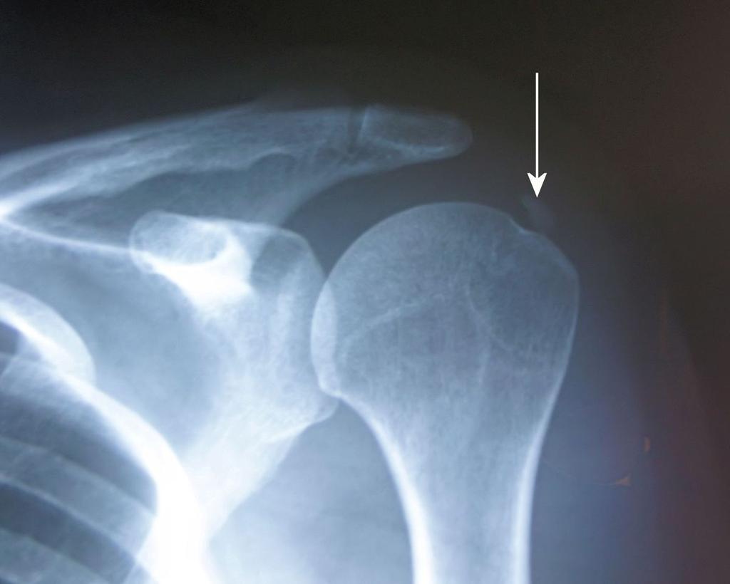 Fig. 5: Calcific tendinitis, Stage 2. Patient presented with a dull pain in the shoulder joint.