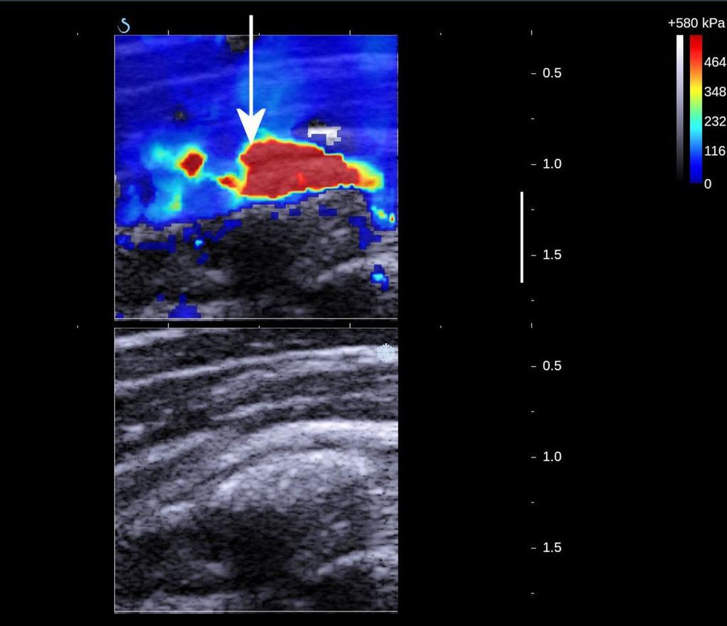 Fig. 7: Calcific tendinitis, Stage 3. Echogram, SWE-mode. Enlarged image of calcification.