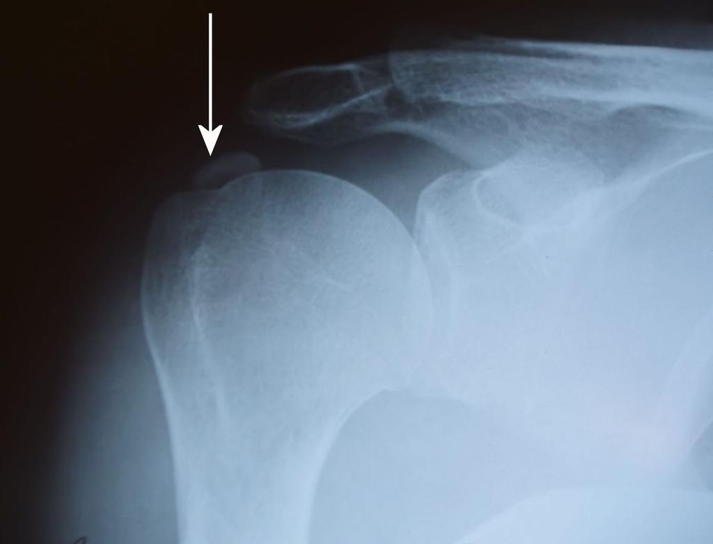 Fig. 8: Calcific tendinitis, Stage 3. X-ray. AP view.