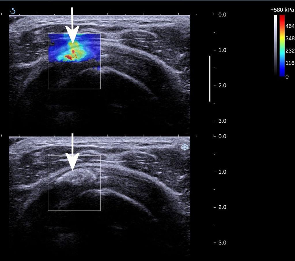 Fig. 9: Supraspinatus tendon. Echogram, SWE-mode. Linear scan.