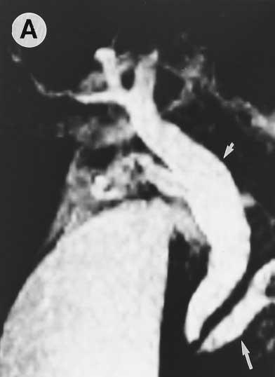 February 1996 MR CHOLANGIOGRAPHY: COMPARISON WITH ERCP 591 Figure 1. Normal biliary tree.