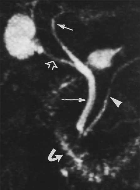 The normal gallbladder and cystic duct (open arrow), pancreatic duct (arrowhead), and duodenum (curved arrow) are also well shown. malities.