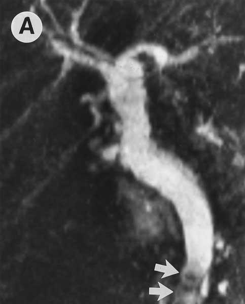 592 SOTO ET AL. GASTROENTEROLOGY Vol. 110, No. 2 tion of the left intrahepatic biliary ductal system, caused by a cholangiocarcinoma encasing the distal left hepatic duct.