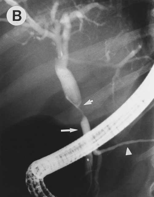 The normal distal common bile duct (long arrows) and pancreatic duct (arrowheads) are also seen in both cholangiographic studies.