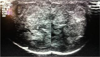 associated with phimosis and ulceration of the glans Figure 2.
