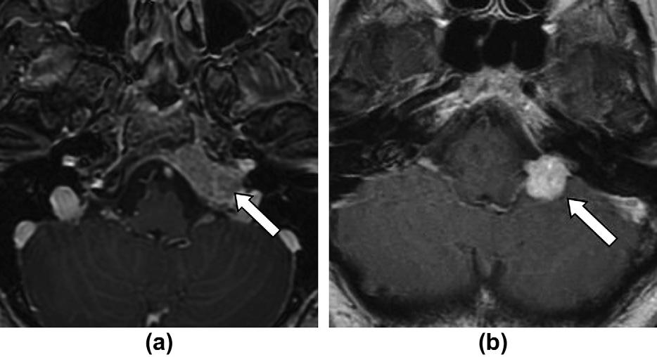 216 A. Christie, E. Teasdale / Clinical Radiology 65 (2010) 213 217 Figure 2 (a) Axial gadolinium-enhanced MRI images of a left-sided glomus tumour (arrow) and (b) left-sided neuroma (arrow).