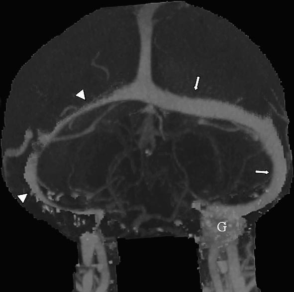 On first principles it would be expected that the enhancement of a meningioma would be less than a glomus tumour and more than a neuroma, but there are no confirmatory observations.