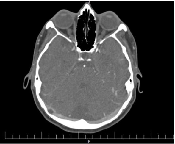 2463 Figure 5. The figure showed Arachnoid granulations of right transverse sinus in CTA. all patients underwent both HRCT and CTA/V separately.