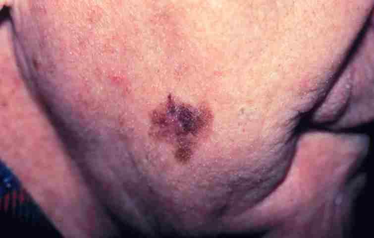 This lesion will have existed 10-15 years and later develop blue black nodules (figure 12).