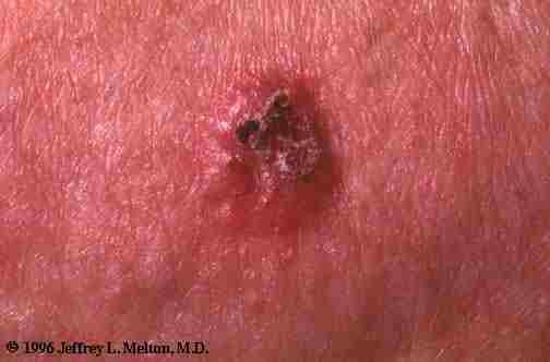 These papules contain telangiectasis which is abnormally dilated blood vessels (figure 1).