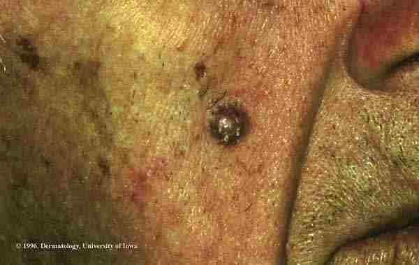 Most of this type of (BCC) occur on the face but can also occur on the trunk and extremities.