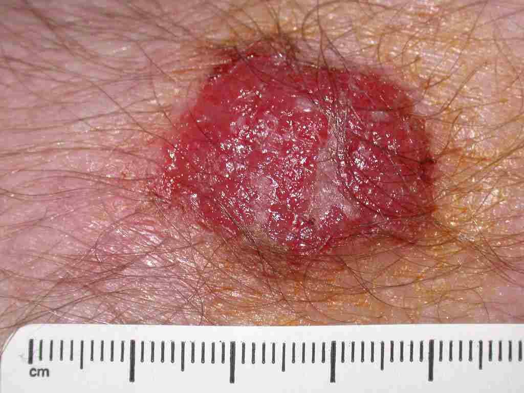 Page 6 of 15 Similar to actinic keratosis, lesions may appear as scaly pink patch or a thin patch with sharply demarcated borders that is associated with Bowen s