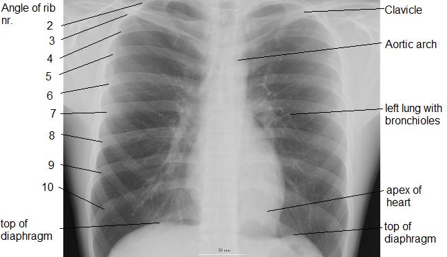Chest X-ray of Pulmonary TB b Tuberculous Pneumonia with consolidation Miliary