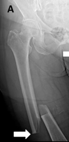 Atypical femoral fractures (AFFs) Unique radiographic & clinical features Prodromal pain Prolonged BP use