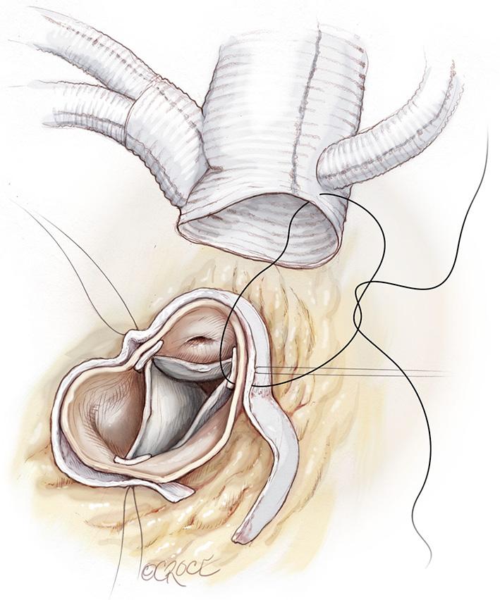 Dacron graft interposition, should be very close to its origin from the arch to permit a subsequent easier detachment and reimplantation of IT in an arterial zone not used for this cannulation