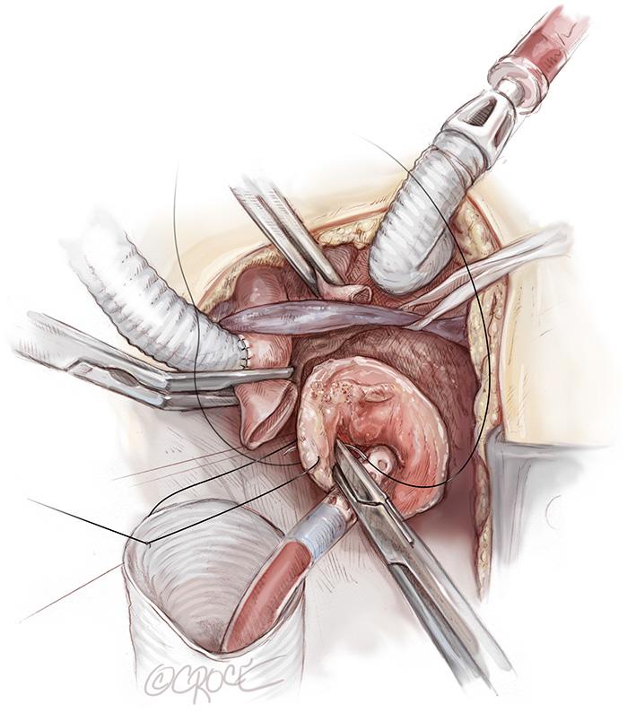 Annals of cardiothoracic surgery, Vol 7, No 3 May 2018 425 Figure 6 Once the proximal aortic anastomosis is completed, the distal aortic anastomosis can be performed either in Criado zone zero