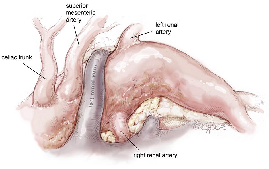 Annals of cardiothoracic surgery, Vol 7, No 3 May 2018 427 Figure 9 In the second surgical stage a mid-line laparotomy is routinely performed to expose the abdominal aorta and its main branches (the
