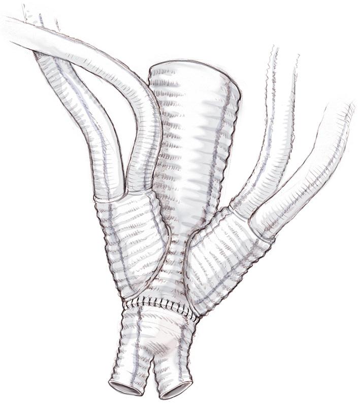 The extent of the distal aortic replacement (either above or below the iliac bifurcation) depends on the involvement of the common iliac arteries in the aneurysm.