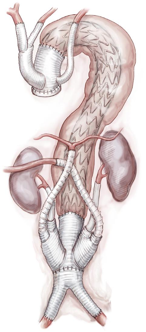 Operation The right femoral artery is generally preferred to the left and if possible a totally percutaneous approach is performed over surgical isolation of the femoral artery, depending on the