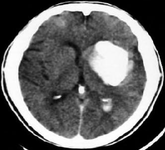 Acute hypertensive response may increase the risk of post-thrombolysis intracerebral hemorrhage Impaired autoregulation +SBP Reperfusion +coagulopathy (Qureshi AI: Circulation 2008 Jul