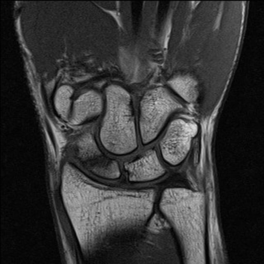 Fig. 2: Unenhanced T1 weighted coronal image shows normal bone marrow signal in proximal scaphoid