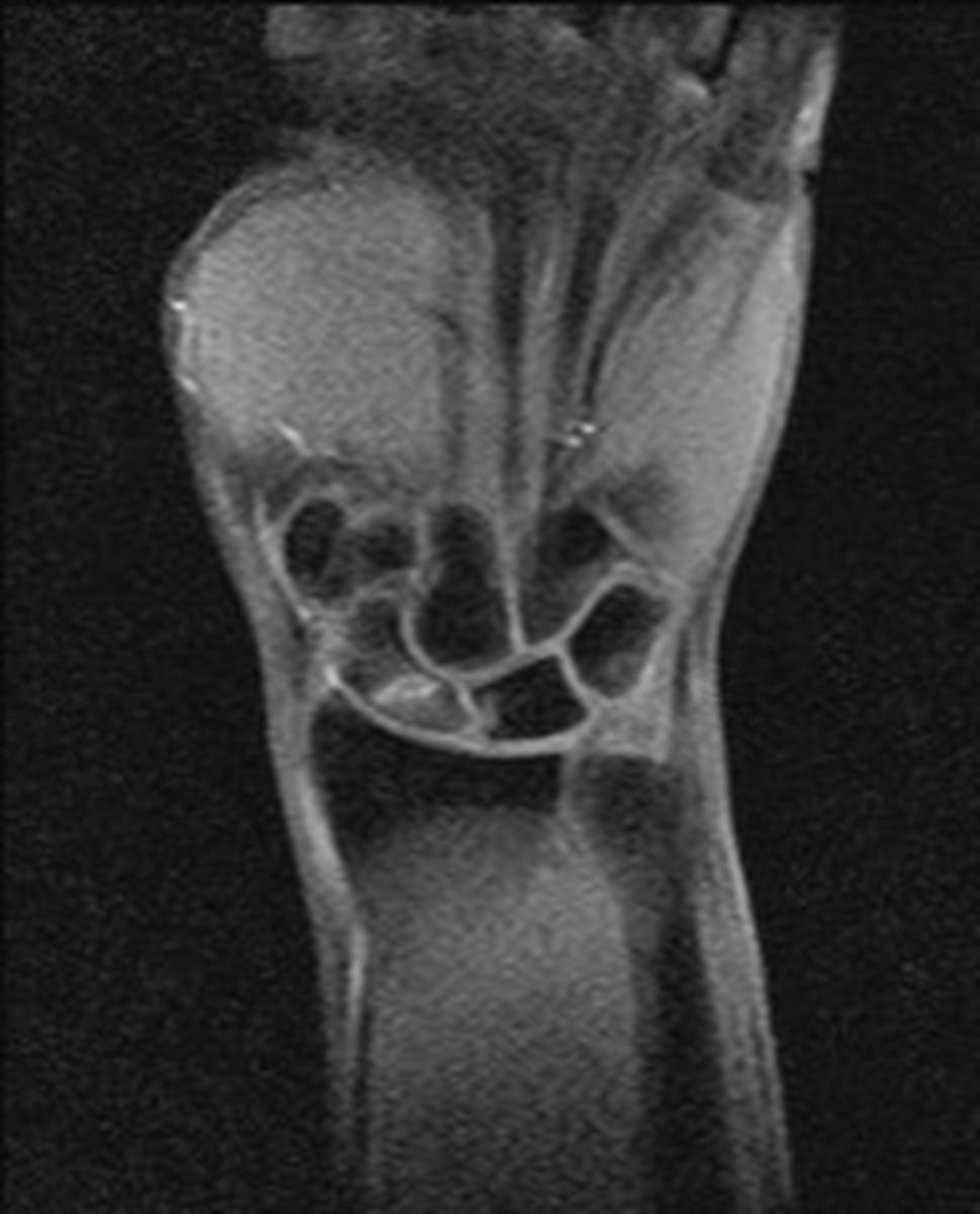 Fig. 3: Enhanced T1 weighted image shows an enhancing proximal scaphoid