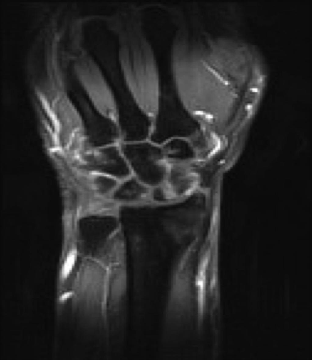 Fig. 6: Following IV Gadolinium administration, there is uptake along the fracture line in the scaphoid waist but no enhancement in the proximal pole indicating avascularity.