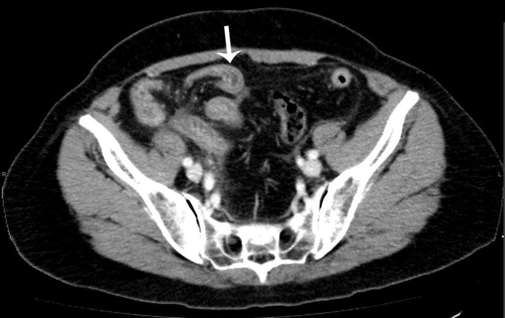 Fig. 1: A 65-year-old woman with intestinal anisakiasis.