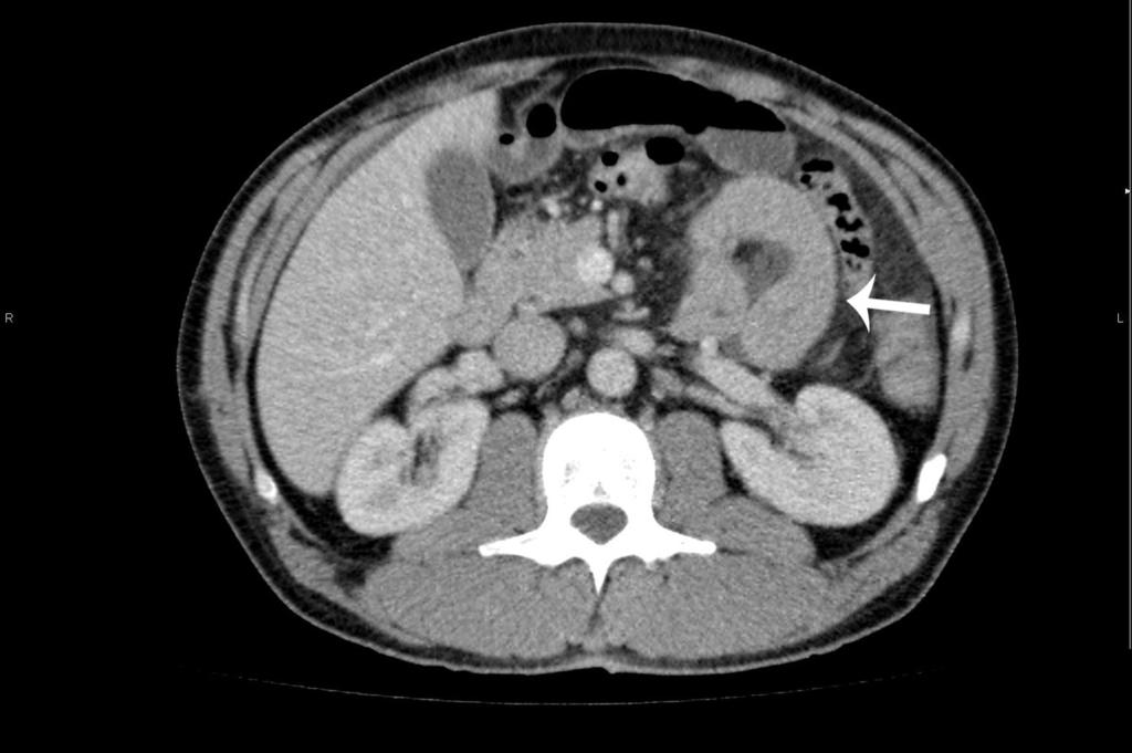 Fig. 2: A 53-year-old man with intestinal anisakiasis.