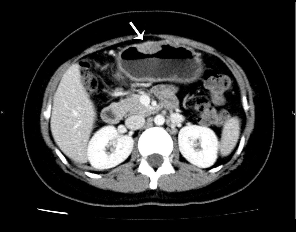 Fig. 4: The CT scan demonstrates ascites in the pelvis. The CT scan of the patient with gastric anisakiasis showed marked focal submucosal edema, simulating a gastric submucosal mass.