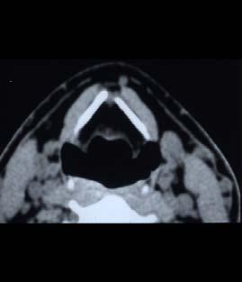CASE 1 Treatment of head and neck cancer : New linac with internal motorized wedge