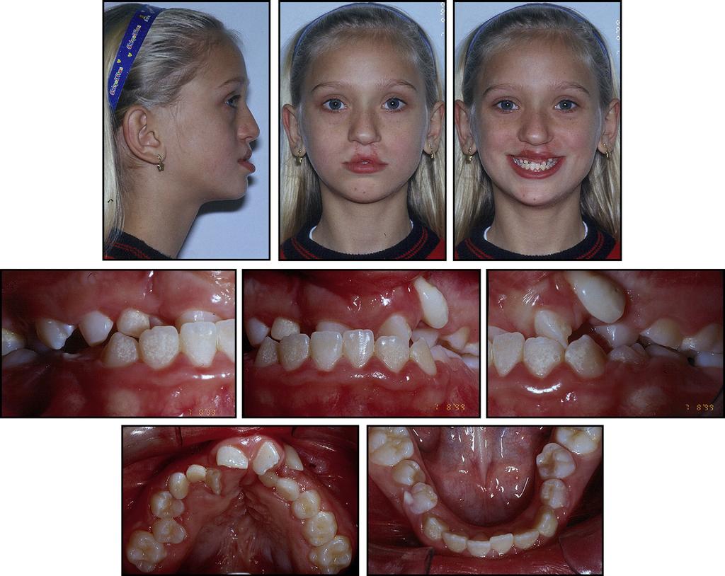 Rocha et al S141 Fig 1. Pretreatment facial and intraoral photographs at age 9 years 8 months.