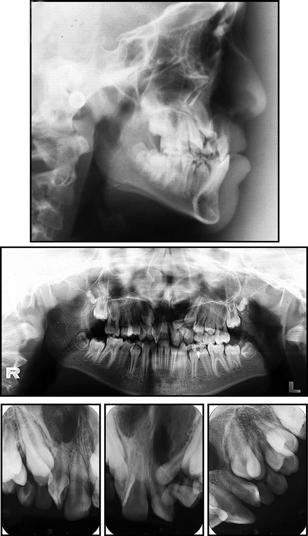 Rocha et al S143 Fig 4. Pretreatment hand-wrist radiograph. Fig 3. Pretreatment cephalometric, panoramic, and periapical radiographs. the maxillary incisor angulation.