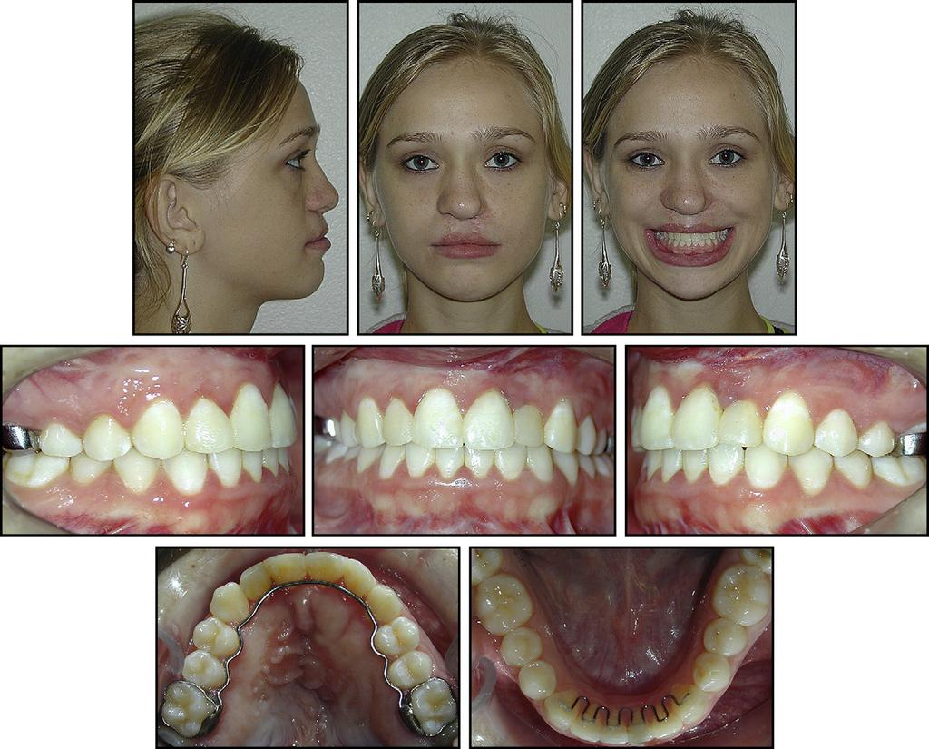 S144 Rocha et al Fig 5. Posttreatment facial and intraoral photographs at age 16 years 7 months.