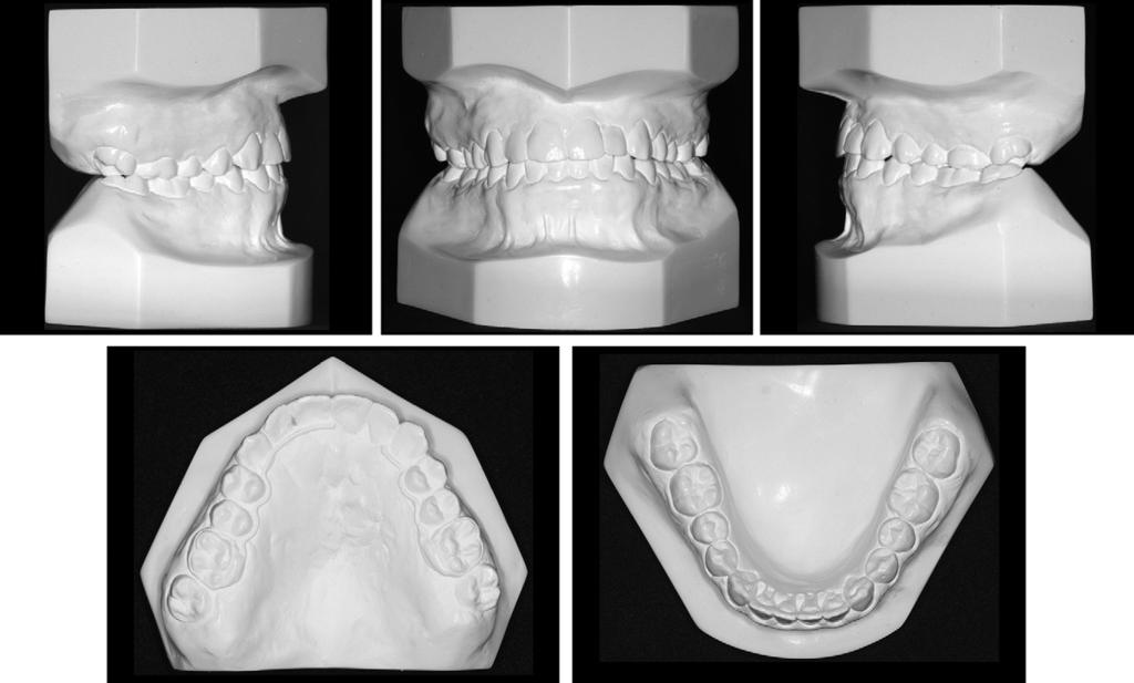 Rocha et al S145 Fig 6. Posttreatment study models. establishing a bony bridge, problems with adjacent tooth eruption, and lack of nasal support.