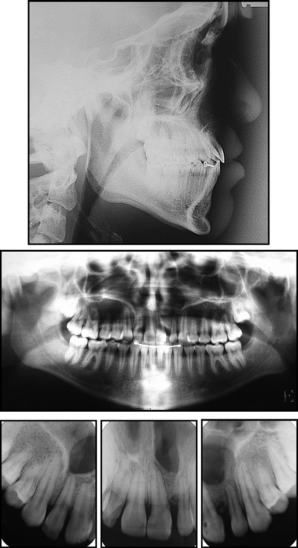 S146 Rocha et al Fig 7. Posttreatment cephalometric, panoramic, and periapical radiographs.