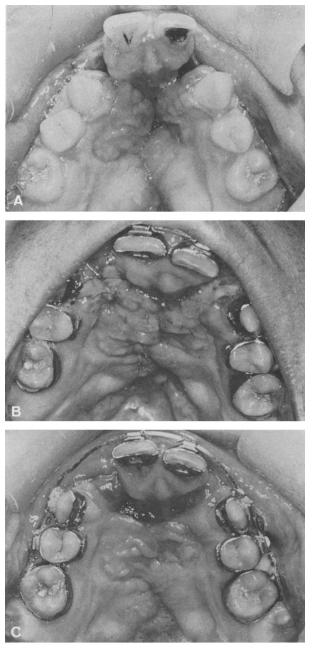 THE SURGICAL ANATOMY OF SECOND.ARY CLEFT LIP 91 Fig. 10 Figu re 10-(A). Adult bilateral cleft prior to reconstruction of alveolar defects.