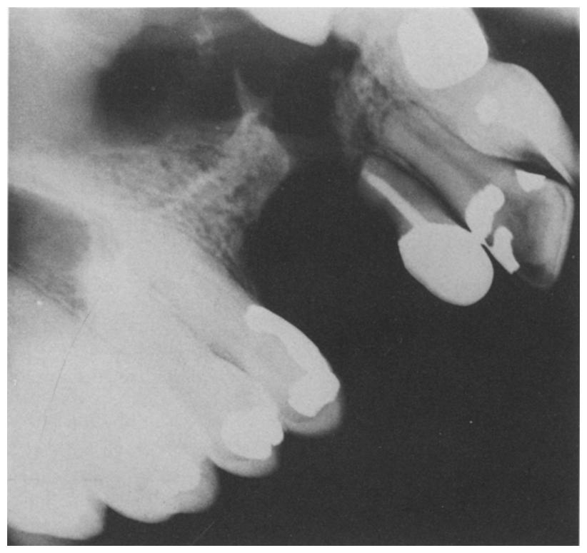 T H E S U R G I C-A L A N A.~-O~~!_~~$~.~;~.Ry,_C.~EB T L-1 P 83 Fig. 4 Figure 4-Failure of alveolar graft in area adjacent to the lateral incisor.