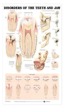 Teeth Common Pathologies (Diseased teeth and gums model) B48976 An