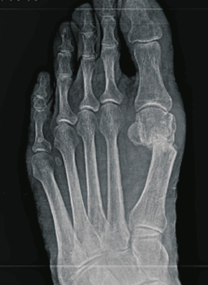 CHAPTER 2 7 Figure 13. Preoperative angle. Figure 14. Postoperative angle. REFERENCES 1. Coughlin MJ. Hallux valgus. J Bone Joint Surg Am 1996;78:932-66. 2. Mann RA, Coughlin MJ: Adult hallux valgus.