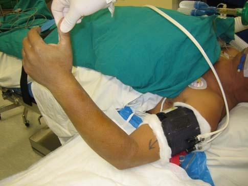 Use of Tourniquet Frequently used for procedures involving forearm To provide a bloodless field to facilitate surgical