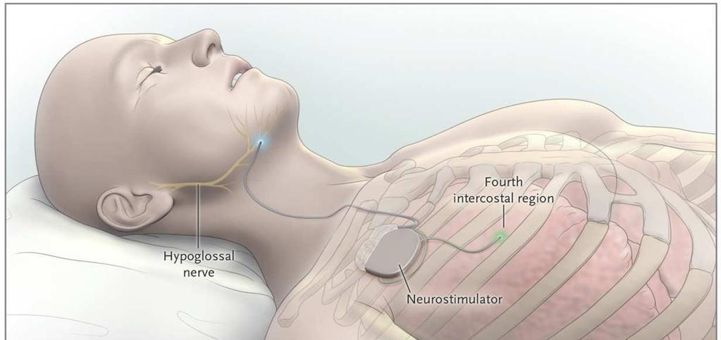 FOR ALL CPAP PATIENTS CONSIDER: Hypoglossal Nerve Stimulation AKA: Sleep Apnea Pacemaker General Sleep Hygiene. Weight Loss. Off Back Positioning (positional tee shirt).